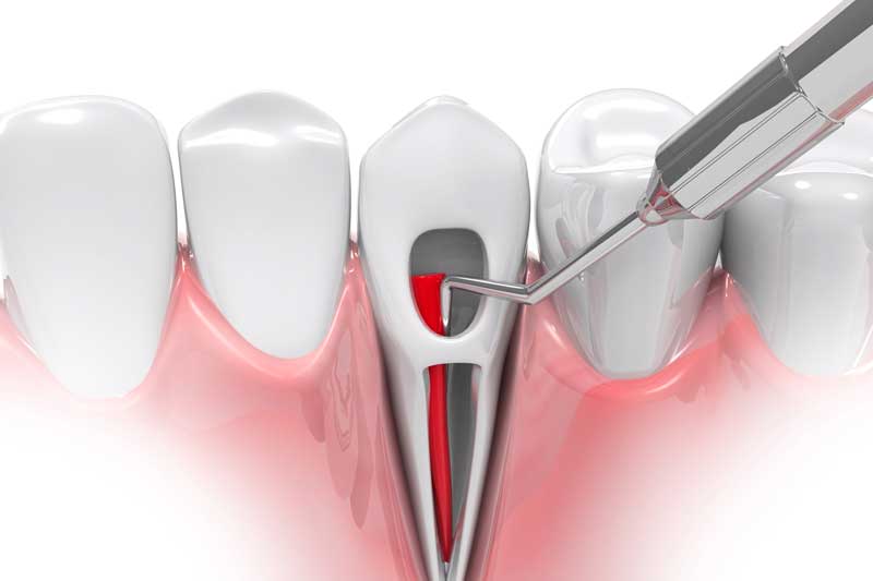 root canal treatment rendering