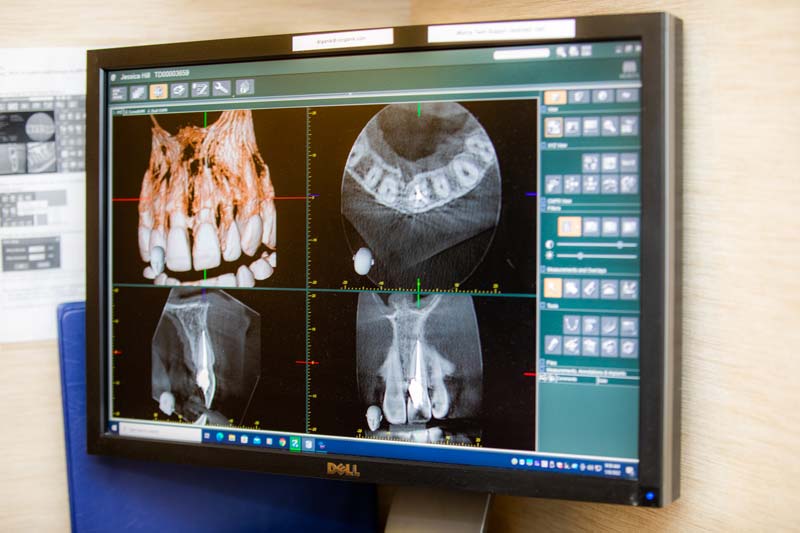 Dental Xrays for diagnosis