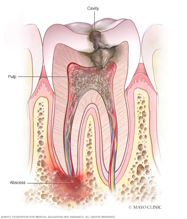 tooth abscess graphic