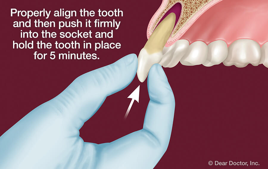 luxated teeth treatment