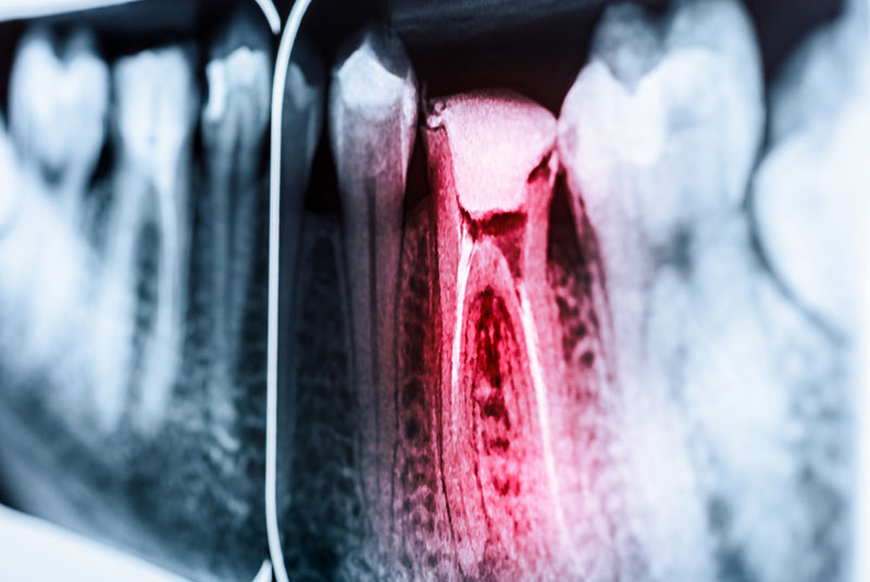 X-Ray of a Root Canal