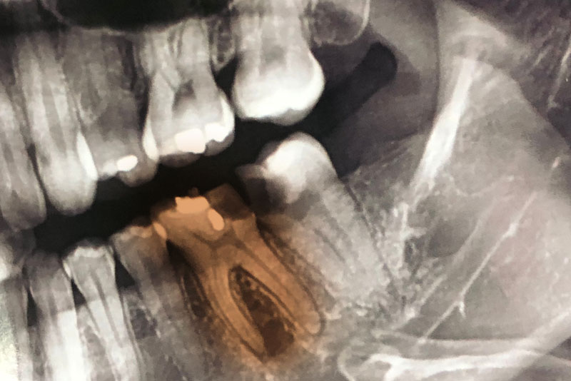 X-Ray Of A Damaged Tooth Needing A Root Canal